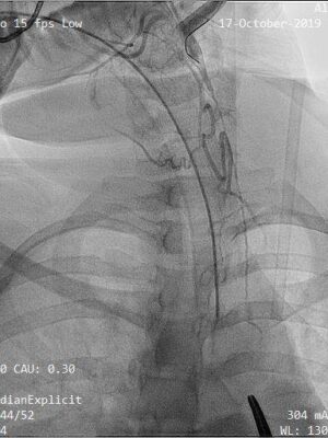 Dr AM Thirugnanam, retrograde carotid angioplasty