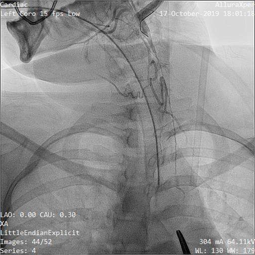 Dr AM Thirugnanam, retrograde carotid angioplasty