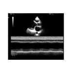 Heart Failure Echo