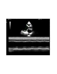 Heart Failure Echo