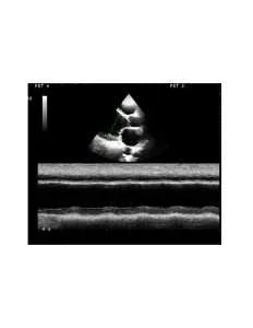 Heart Failure Echo