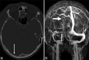 Sinus Venous Thrombosis