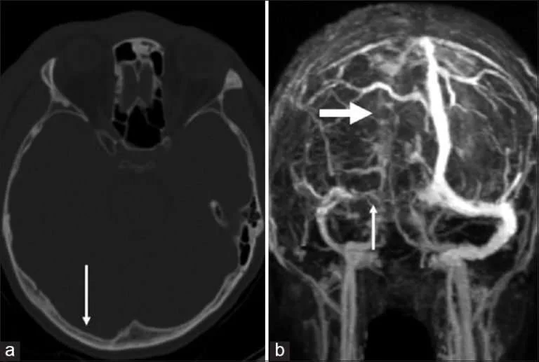 Cerebral Venous Thrombosis 7 Sinus Venous Thrombosis