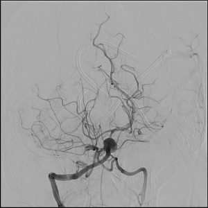 intracranial aneurysm