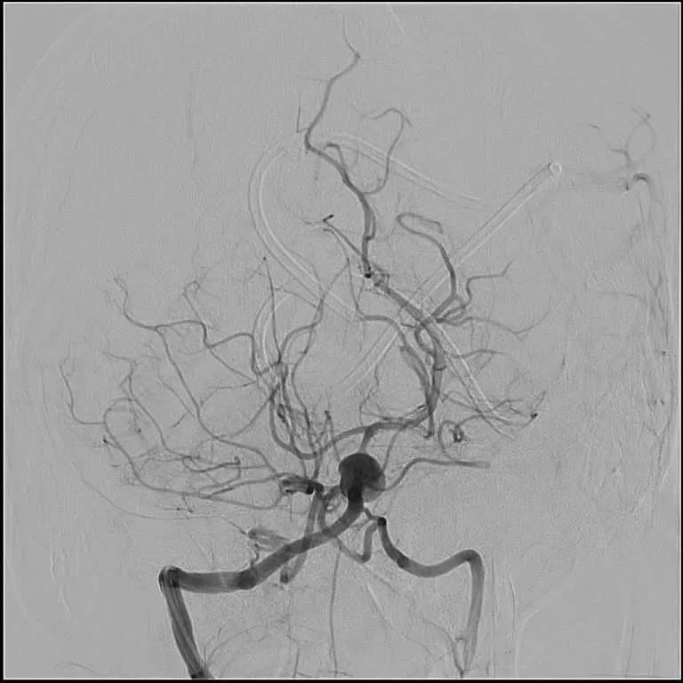 Cerebral Aneurysm 6 intracranial aneurysm