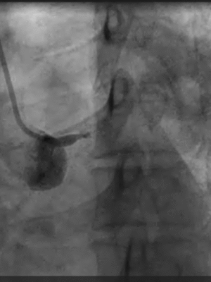 LM total occlusion, Dr AM Thirugnanam