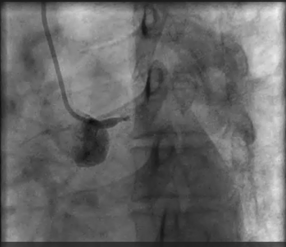 LM total occlusion, Dr AM Thirugnanam
