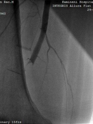 Leg artery thrombosis, Dr AM Thirugnanam
