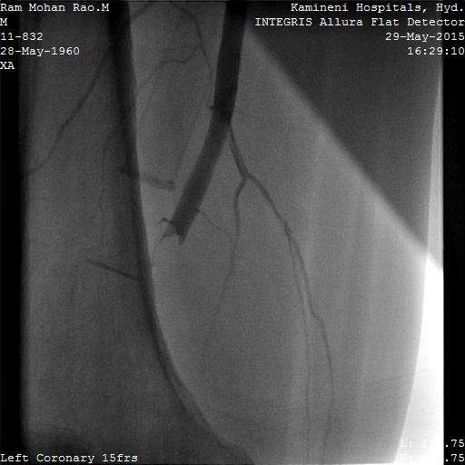 Leg artery thrombosis, Dr AM Thirugnanam