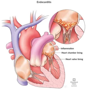 infective Endocarditis