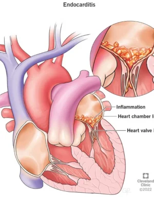 infective Endocarditis