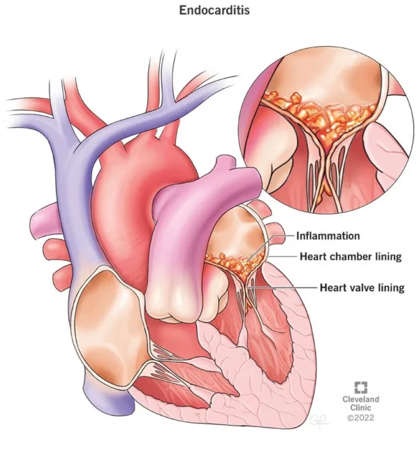 infective Endocarditis