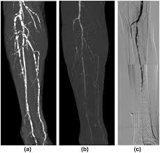 Below the knee disease