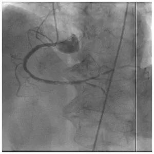 RCA air embolism